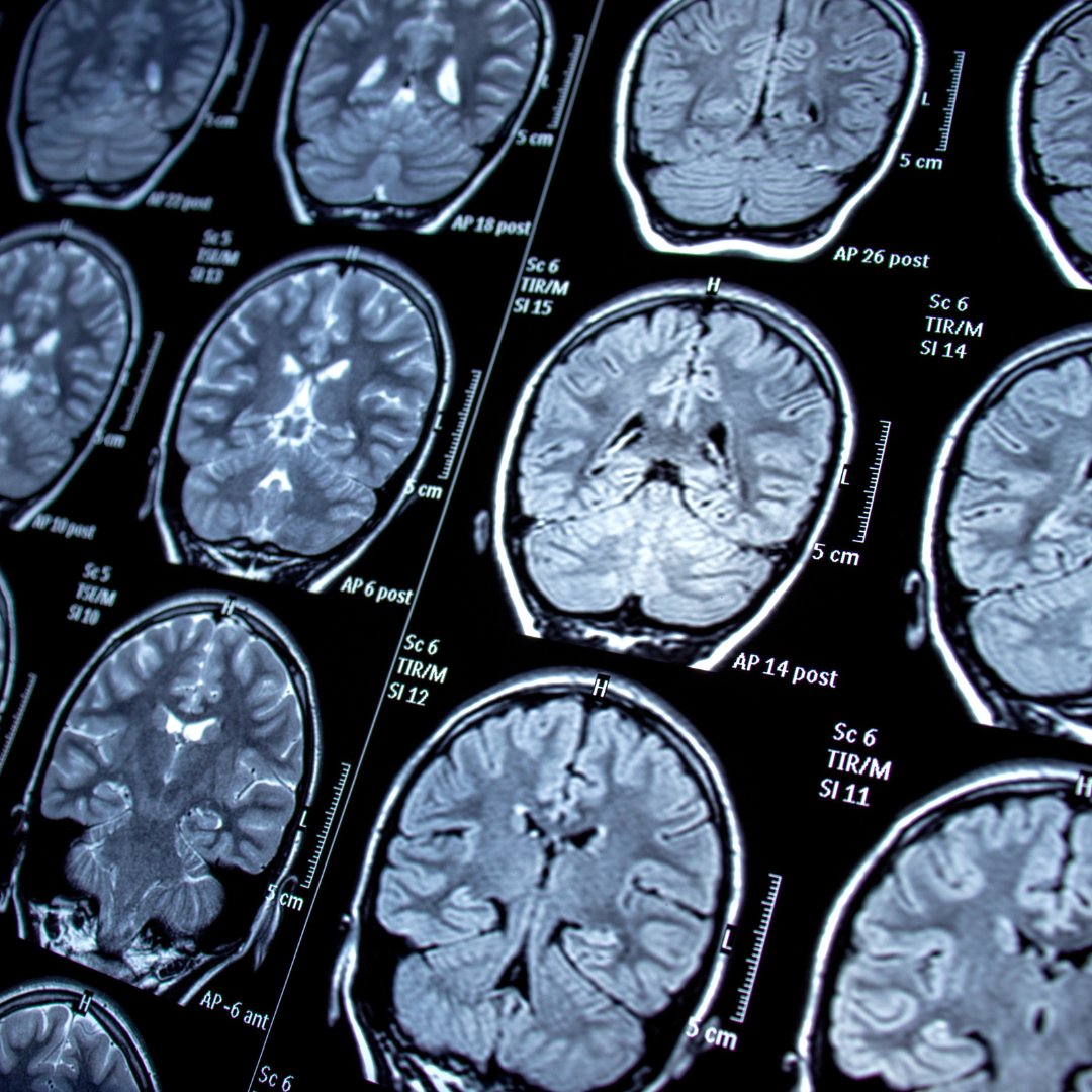 Epilepsy and Hypnotherapy: What You Need to Know - Clearmindshypnotherapy